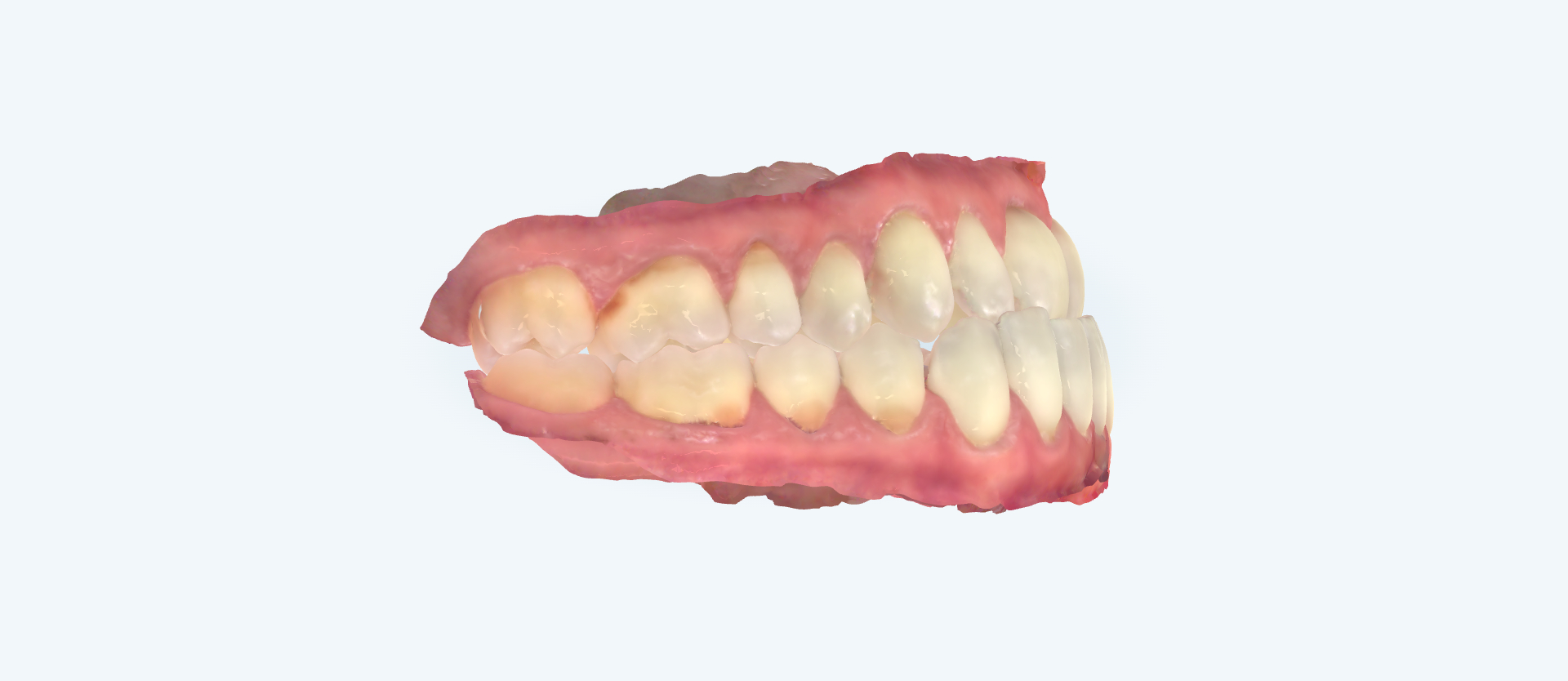 Underbite treatment comparison frontal bite view before